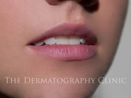 Lip Blush Tattoo - The Dermatography Clinic