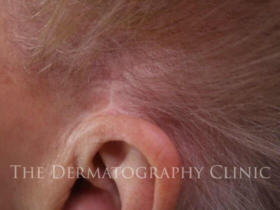 Womens Ear Scar Cover Up Before