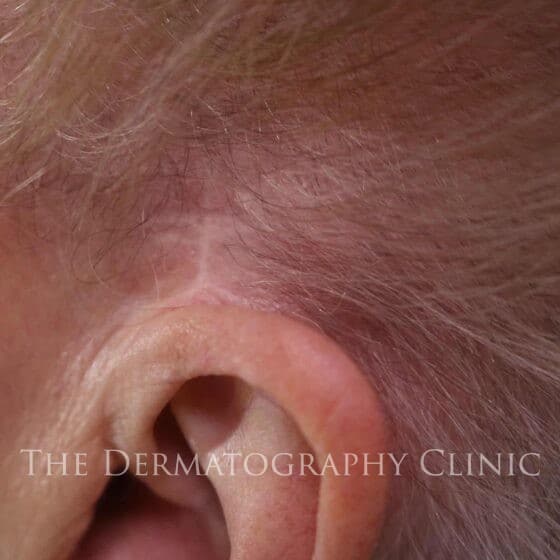 Womens Ear Scar Cover Up Before