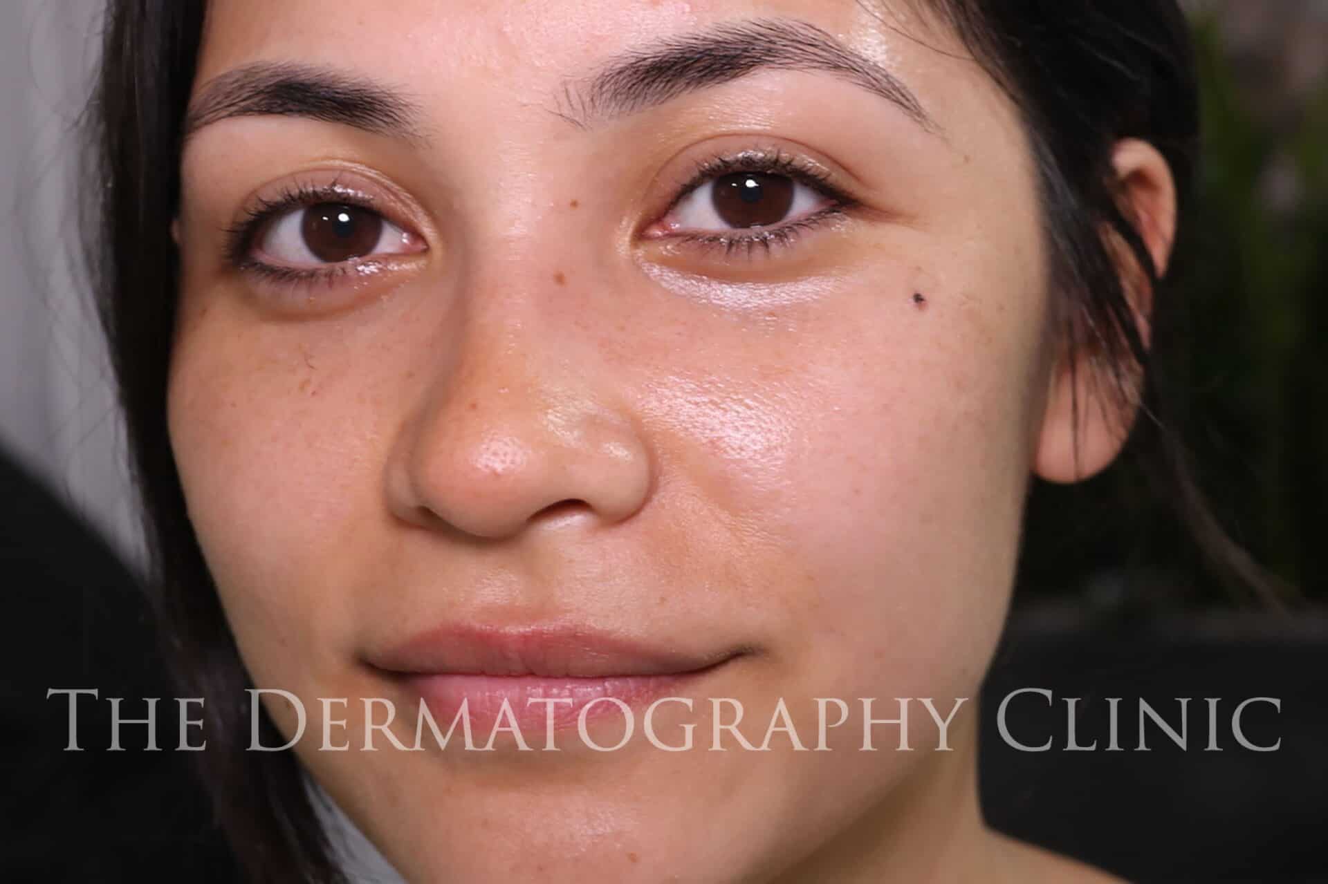 Beauty Spot Tattoo - The Dermatography Clinic