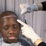 Male-Alopecia-medical-video-9-menu