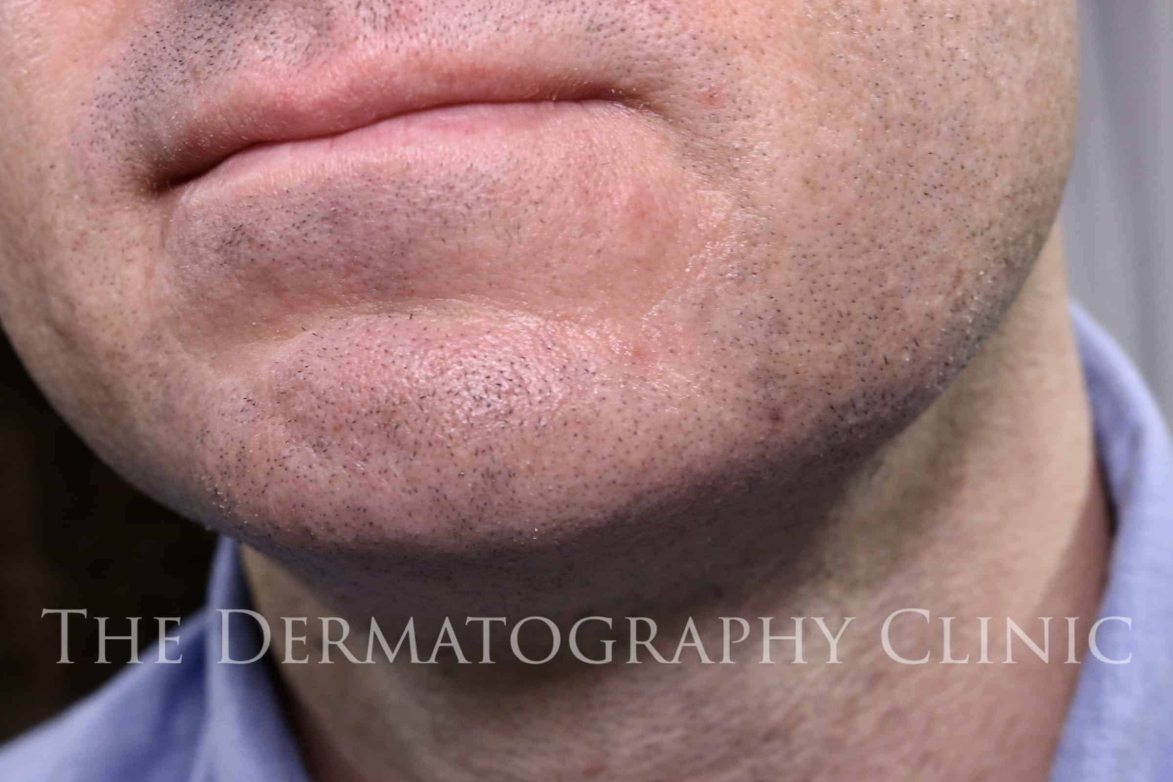 Cosmetic Beard Tattooing or Beard Microblading