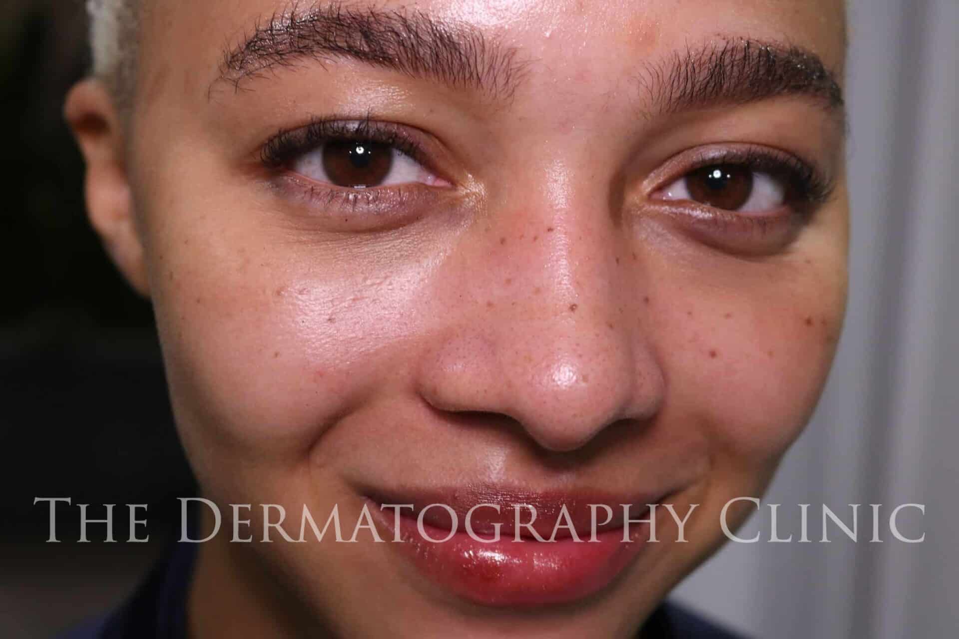 Cheek Tint Tattoo Healing ✨ & Healed Results -Cheek Tint Tattoo looks very  bold and bright immediately following the procedure. Once h... | Instagram