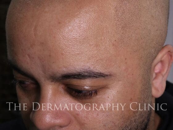 Scalp Micropigmentation After Photo
