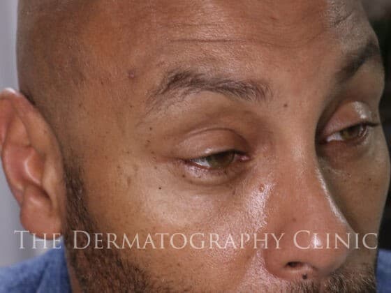 Mature scalp micropigmentation result demonstrating natural appearance and density after long-term healing