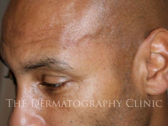 Pre-treatment scalp showing receding hairline and reduced frontal density