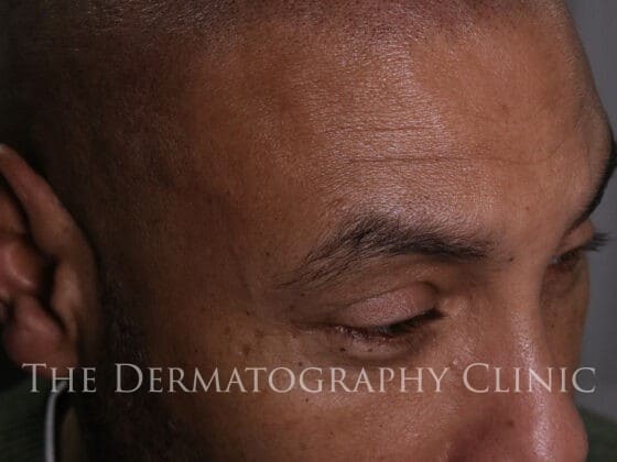 This image shows a long-term scalp micropigmentation result photographed during a follow-up appointment. It demonstrates how the treatment has matured over time while maintaining natural density, blending, and overall balance.