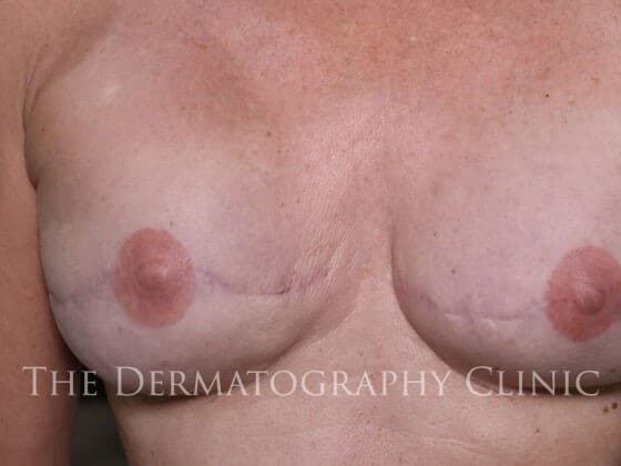 Areola Tattoo After