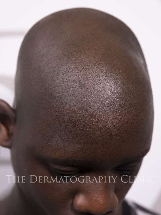 Alopecia In Men Treatment Photo