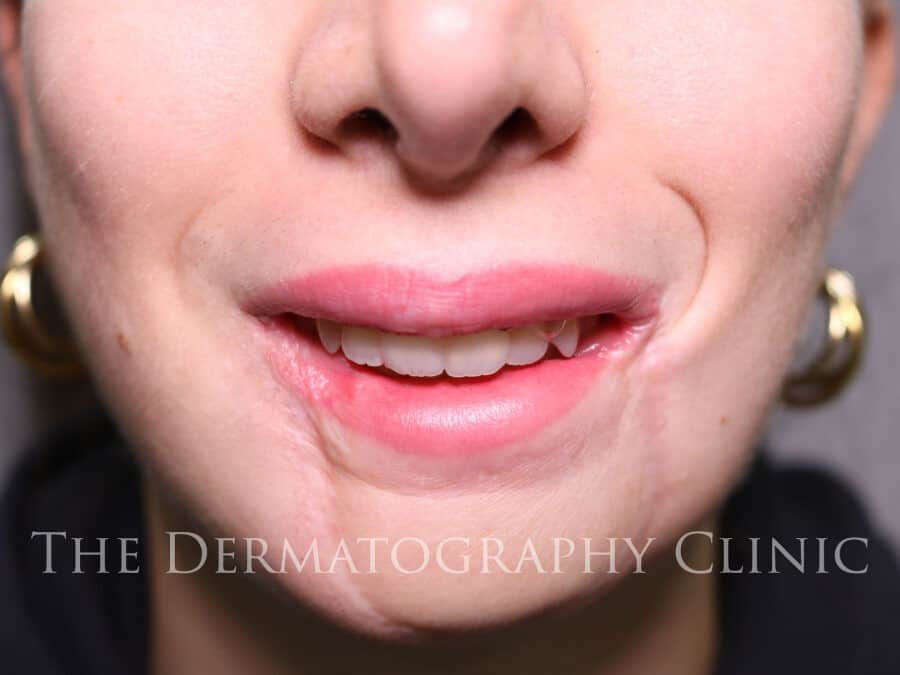 Paramedical Lip Tattoo After 7