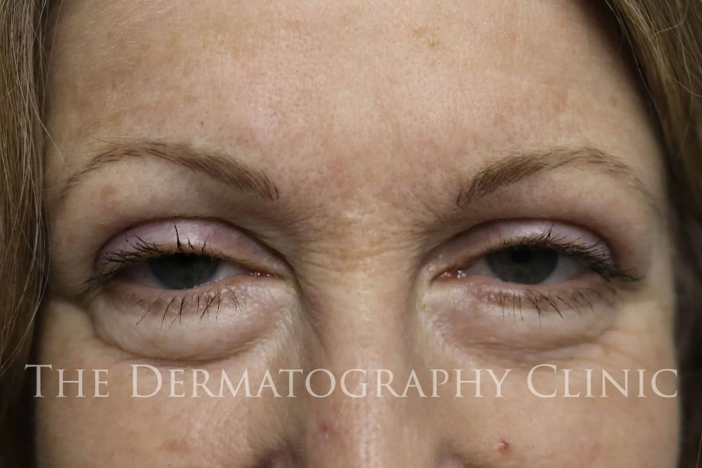 After Nano Stroke eyebrow tattooing for mature women at The Dermatography Clinic Spitalfields