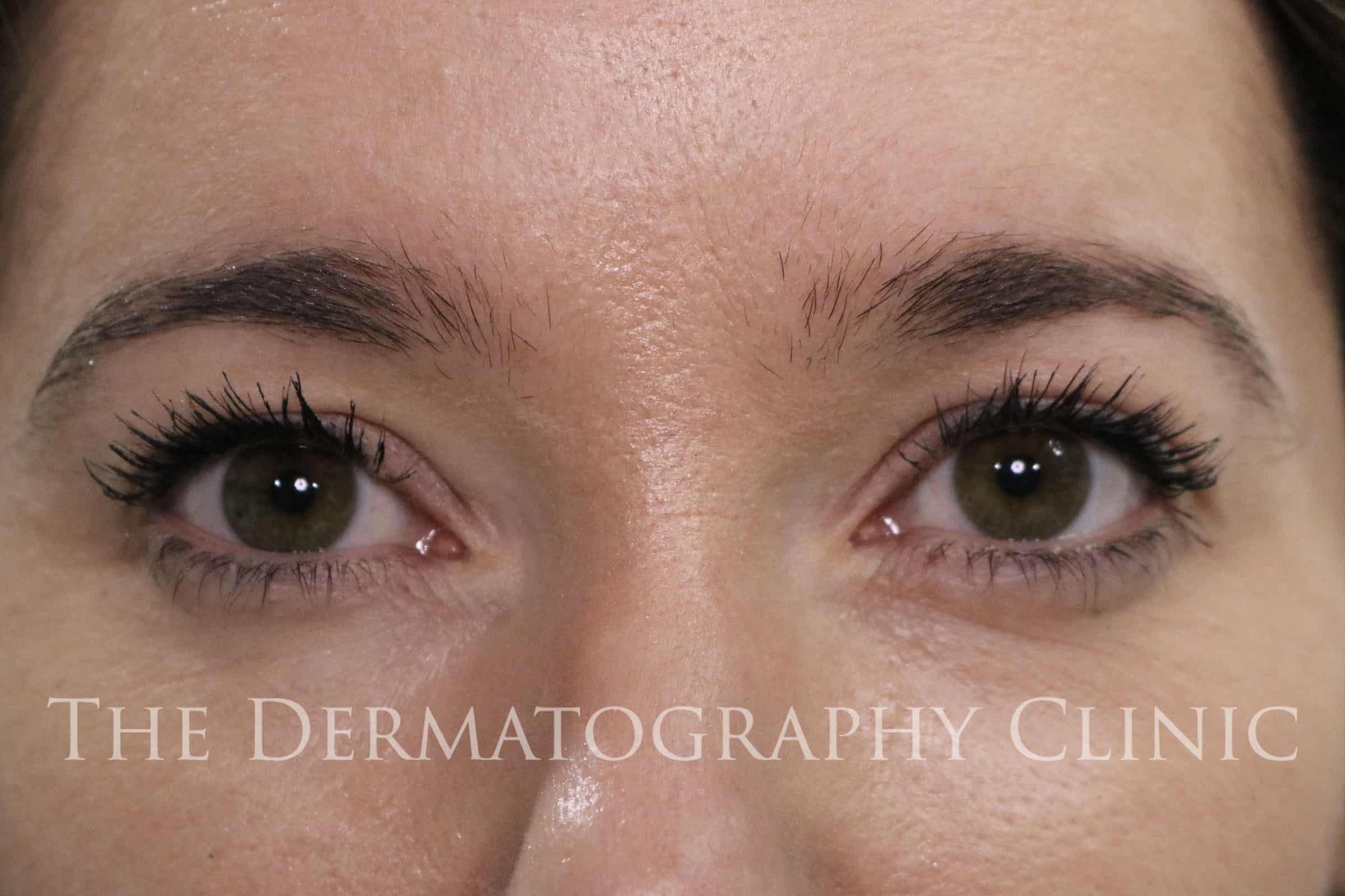 Permanent Eyebrows - The Dermatography Clinic