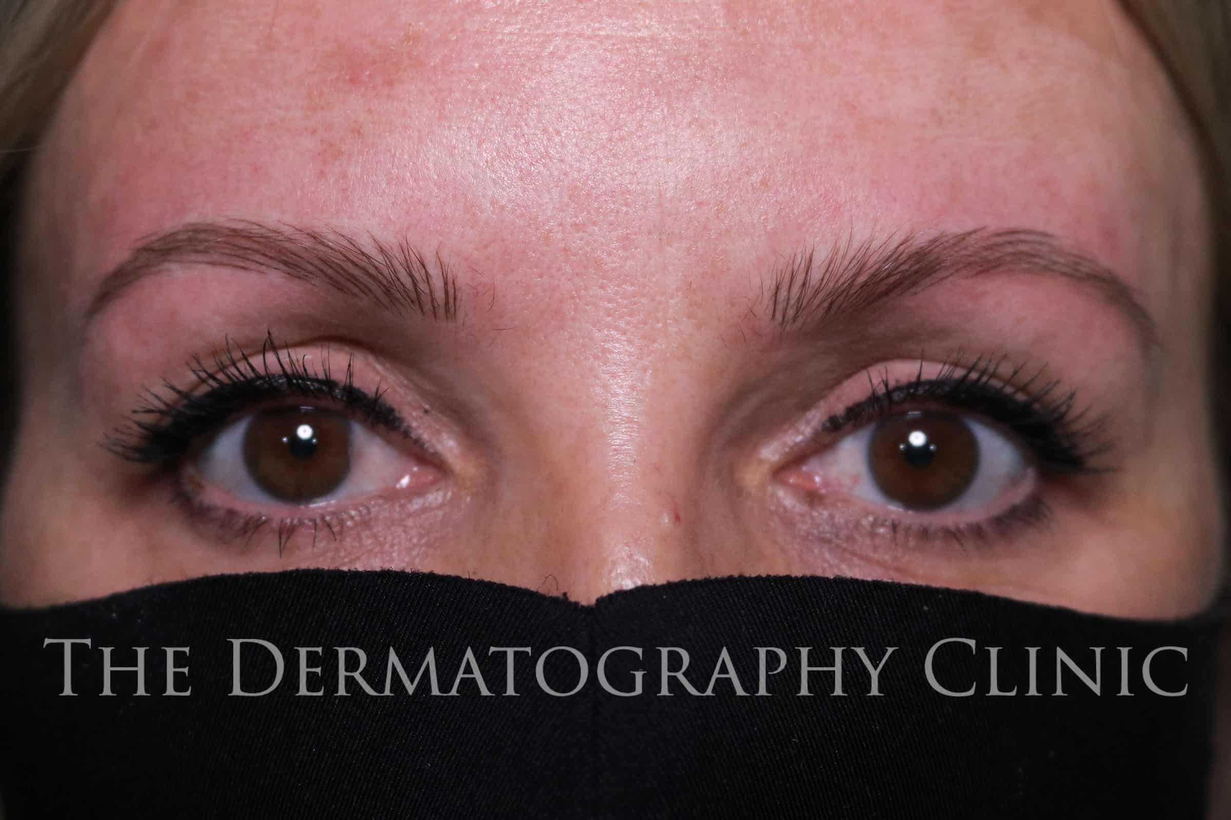 Permanent Eyebrows - The Dermatography Clinic