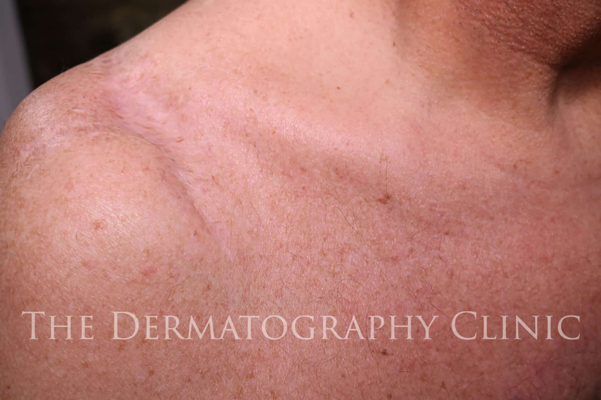 Tattoo scar Stock Photos, Royalty Free Tattoo scar Images | Depositphotos