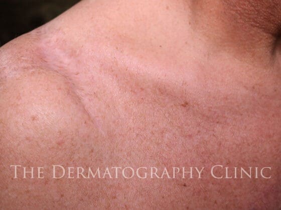 Scar Camouflage For Men Shoulder After Treatment Photo