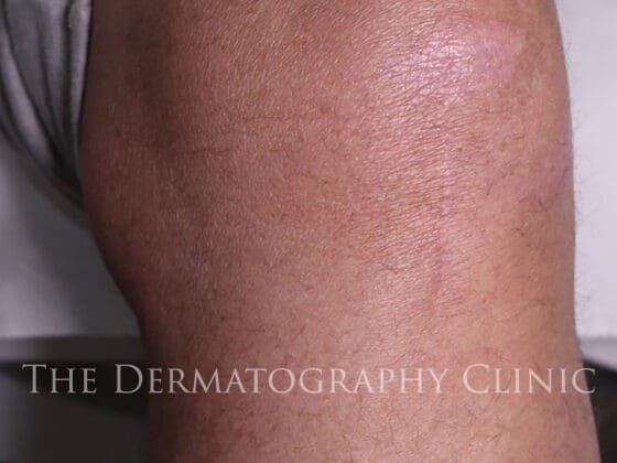 Scar Camouflage For Men Knee After Treatment Photo