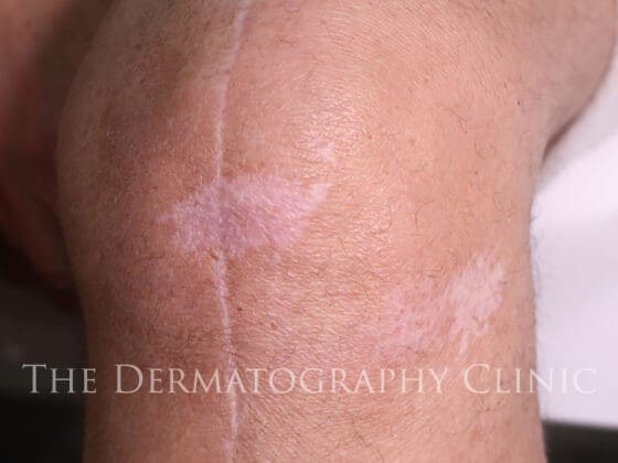 Scar Camouflage For Men Knee Before Treatment Photo