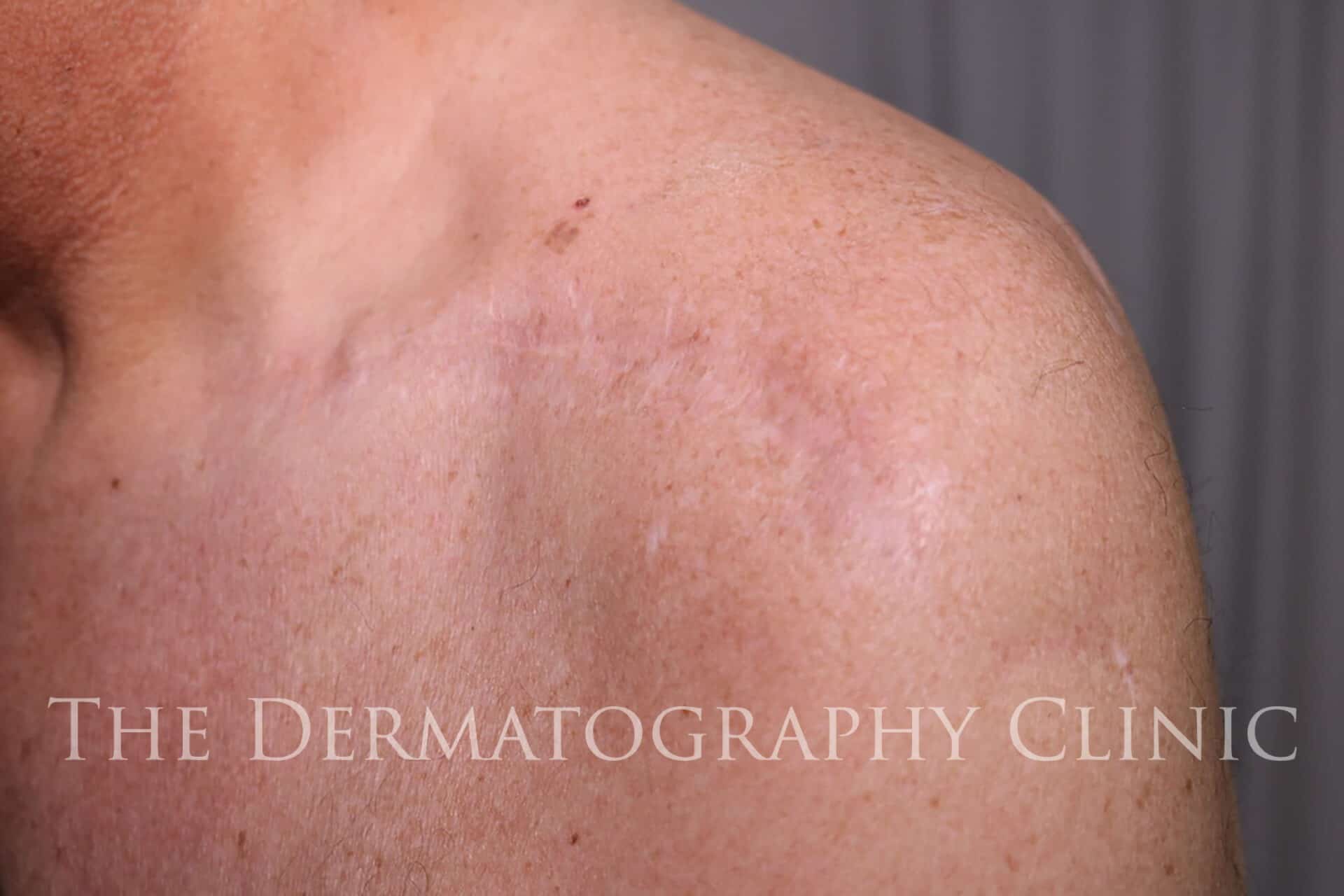 Camouflage tattoo | Self harm scars | One treatment. | Instagram