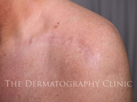 Scar Camouflage For Men After Treatment Photo
