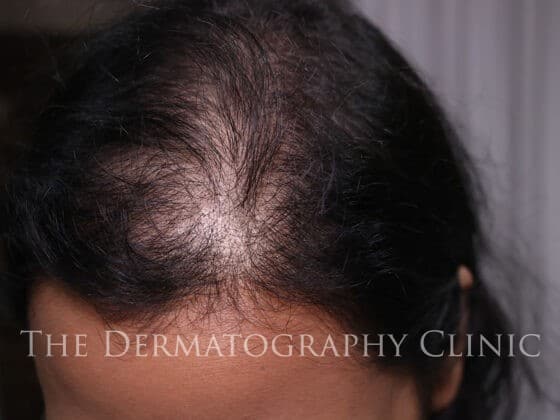 Womens Scalp Micropigmentation