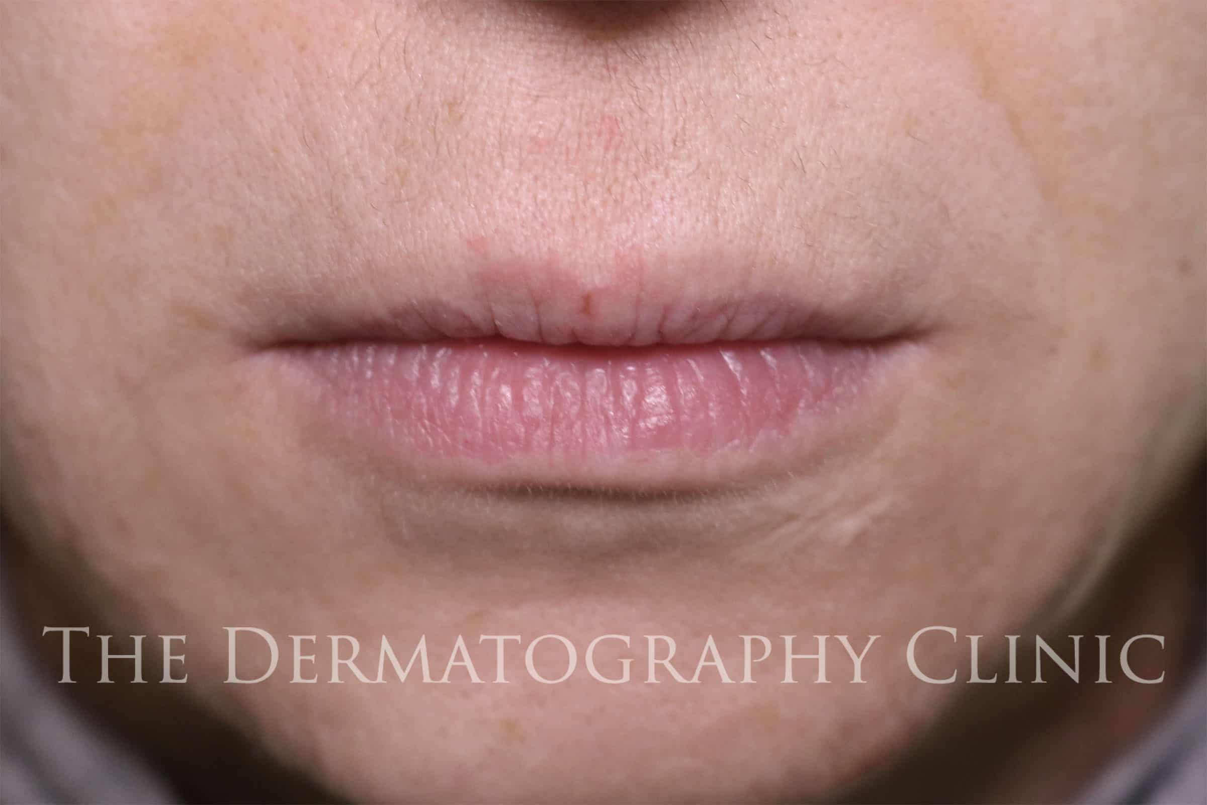 Before image of Rosa's dermatography treatment