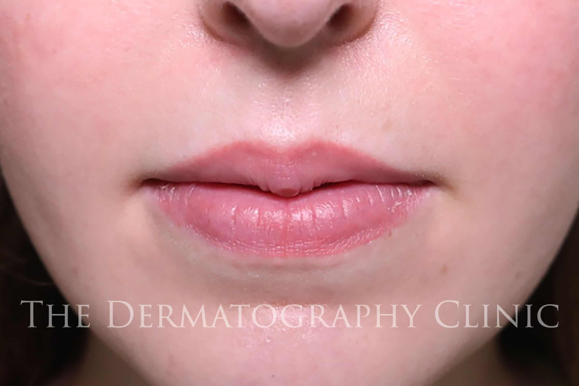 Customer Simone's after dermatography treatment photo