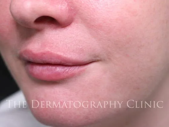 After lip dermafillers treatment