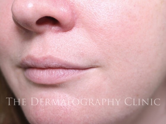 before lip dermafillers treatment