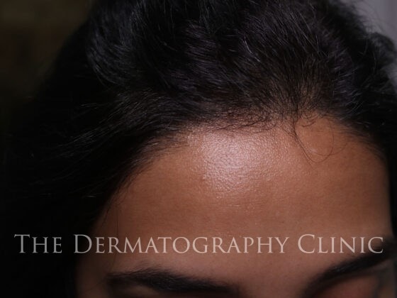 Photo of Scalp micropigmentation’ It is essentially the process of having your scalp cosmetically tattooed with tiny dots.