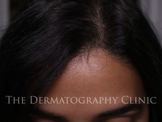 After the process of Scalp micropigmentation’ which is essentially the process of having your scalp cosmetically tattooed with tiny dots.