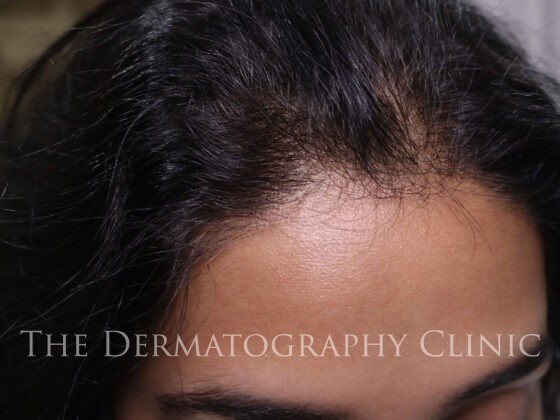 Before Photo. Scalp micropigmentation will be used by this woman to camouflage her thinning hair.
