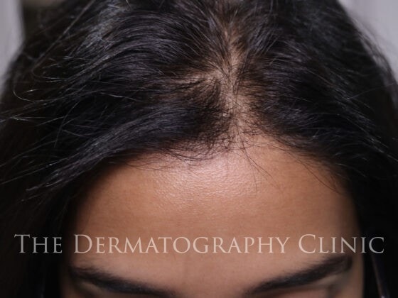 Photo taken Before Scalp micropigmentation treatment. this treatment will be used to camouflage her thinning hair.