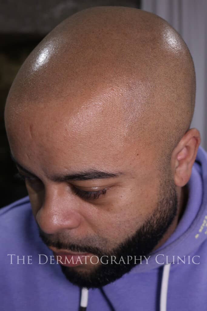 Healed scalp micropigmentation result shown from a front-side angle, demonstrating natural hairline design and seamless blending into the mid-scalp.