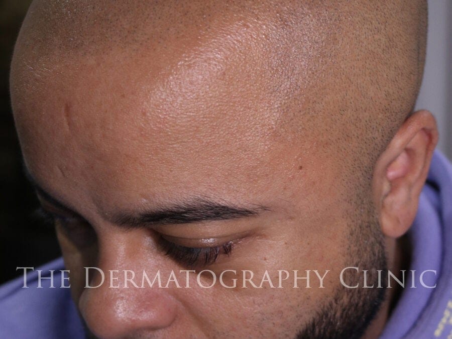 Healed scalp micropigmentation result shown from a front-side angle, demonstrating natural hairline design and seamless blending into the mid-scalp.