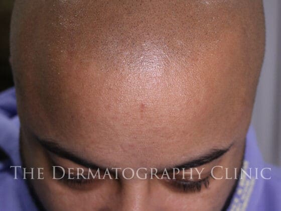 Mens SMP Scalp Micropigmentation photo taken in 2024 long after initial treatment.