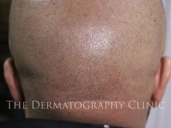 Mens SMP Scalp Treatment, photo taken after very successful treatment.