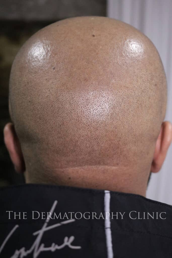Healed scalp micropigmentation showing natural density and soft blending at the back of the scalp