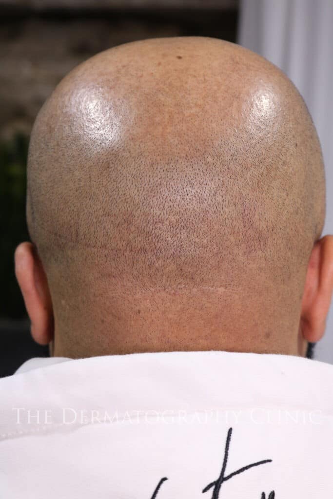 Before image showing crown thinning and reduced scalp coverage prior to scalp micropigmentation treatment