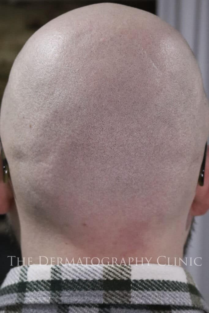 Natural scalp micropigmentation result showing balanced density and seamless blending across the back of the scalp