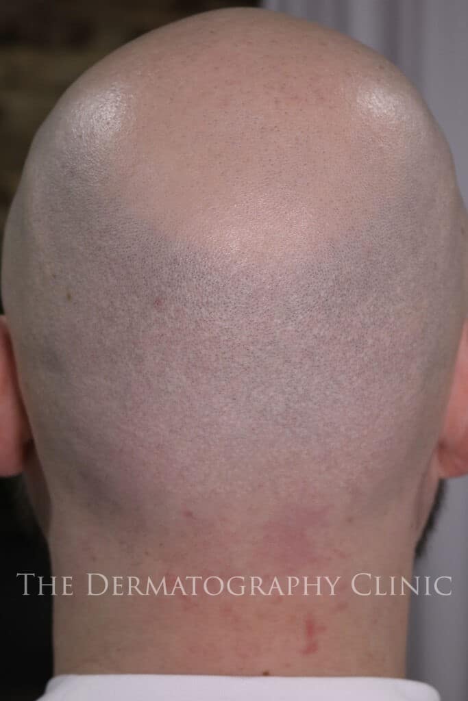 Before scalp showing natural hair loss pattern and reduced density across the crown and mid-scalp