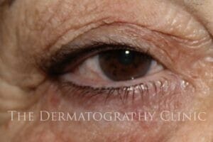 Permanent Eyeliner After Treatment Photo.