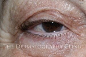 Permanent Eyeliner Before Treatment Photo.