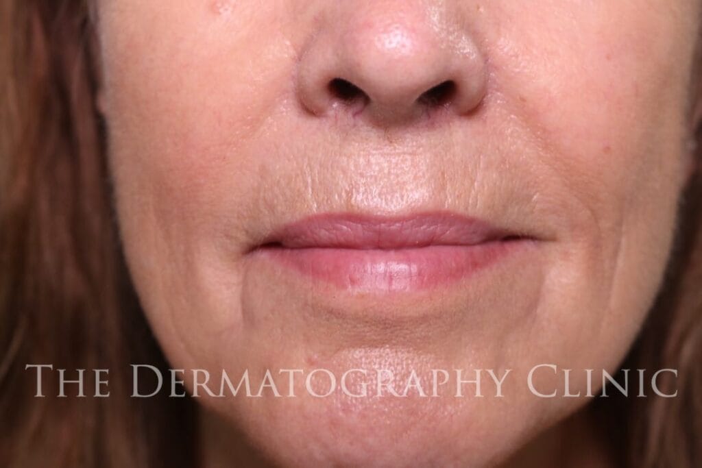 Permanent lip enhancement for mature women at The Dermatography Clinic Spitalfields