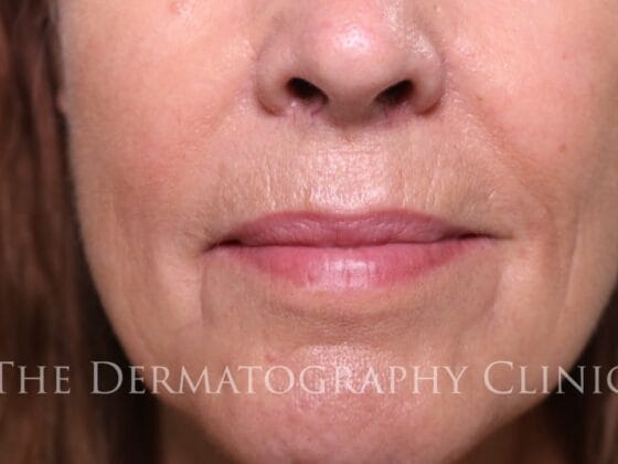 Permanent lip enhancement for mature women at The Dermatography Clinic Spitalfields 