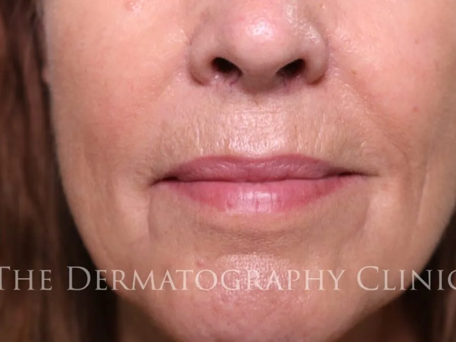 Permanent lip enhancement for mature women at The Dermatography Clinic Spitalfields 
