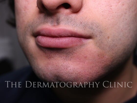Men Vitiligo Tattoo Treatment, after photograph.