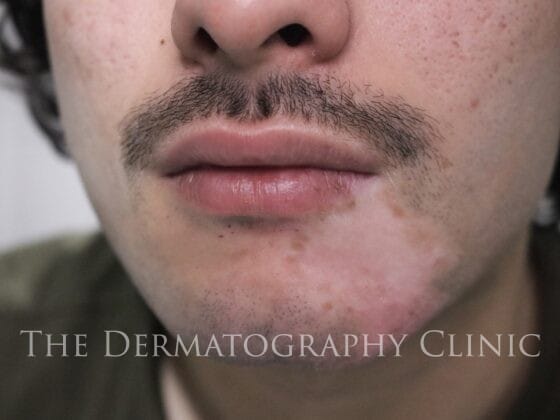 Men Vitiligo Tattoo Treatment, before photograph.