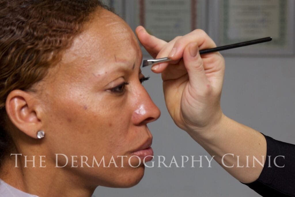 Lady with Alopecia being measured up for her eyebrow tattoo treatment with Renée at The Dermatography Clinic