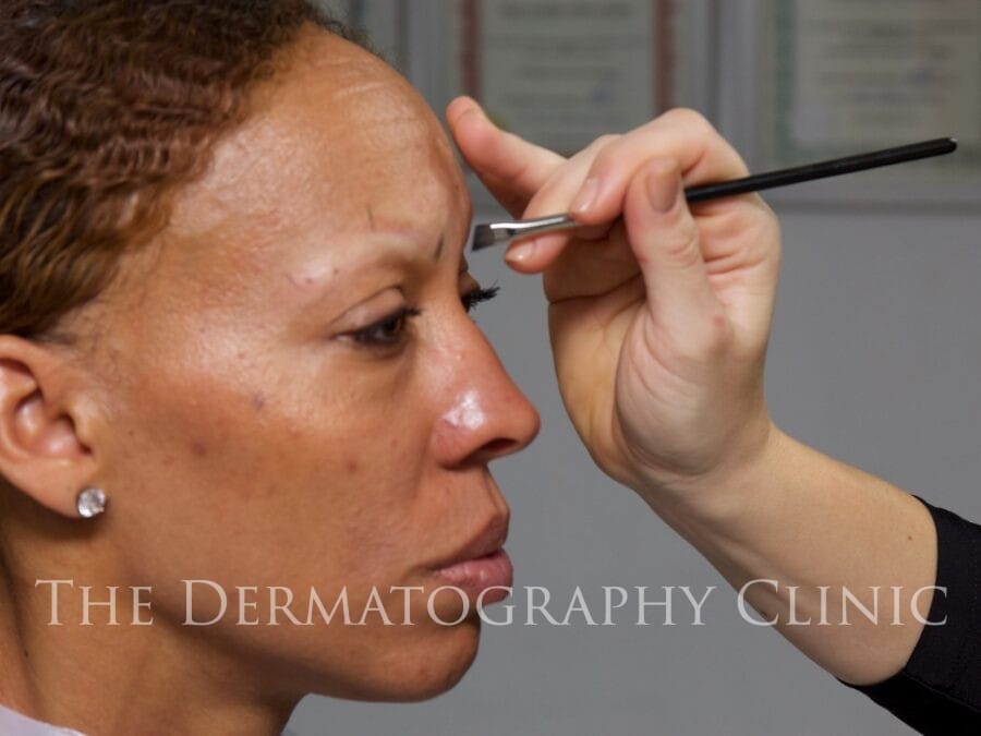 Lady with Alopecia being measured up for her eyebrow tattoo treatment with Renée at The Dermatography Clinic