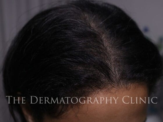 Womens Alopecia Treatment Photograph After Treatment